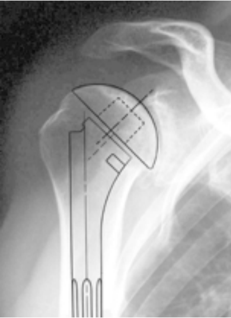 Arthrose Schultergelenk Abb.1