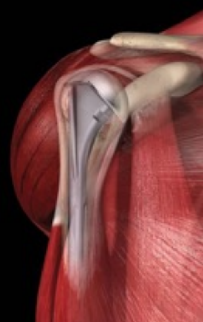 Arthrose des Schultergelenks Abb.1
