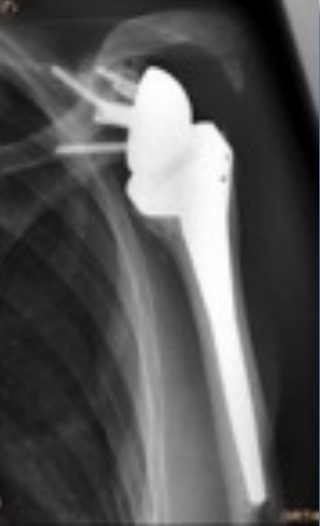 Arthrose des Schultergelenks Abb2 2